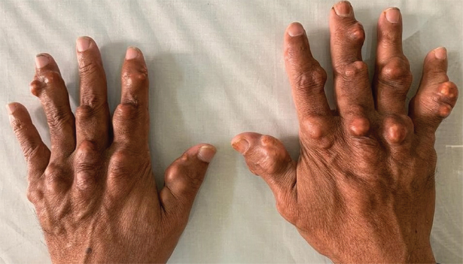 Multiple, firm, non-tender nodules of various sizes on the dorsum of both hands.